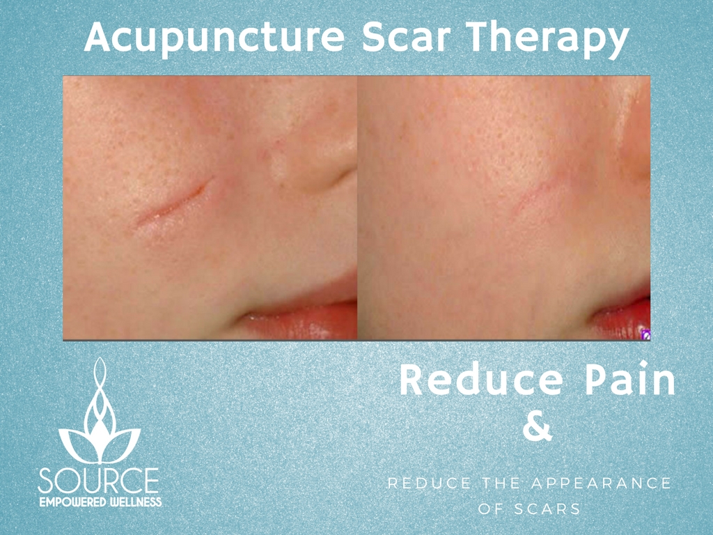 Acupuncture Scar Therapy San Diego Acupuncture (619) 7619544