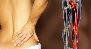 Read more about the article Acupuncture for Sciatica