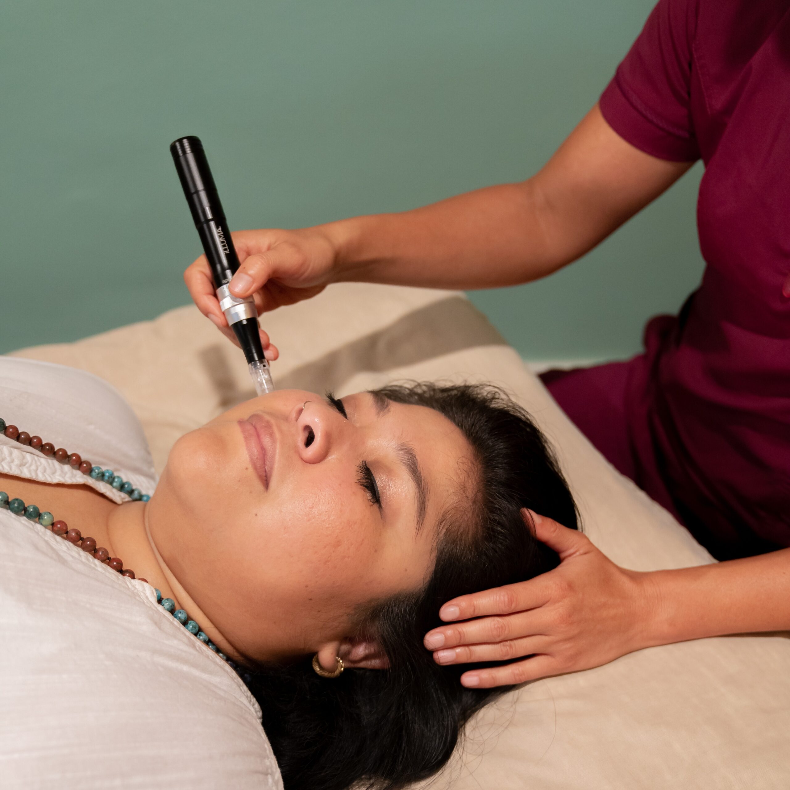 microneedling at Source Acupuncture