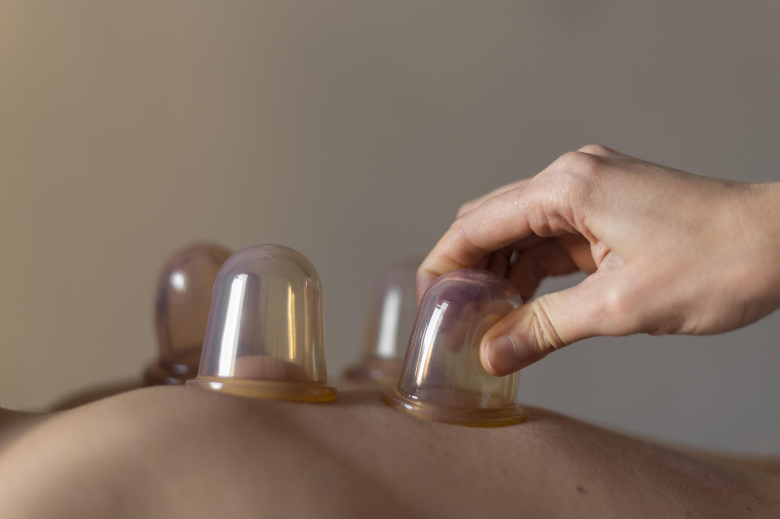 cupping therapy