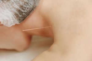 Read more about the article Microneedling vs Cosmetic Acupuncture: What’s the Difference?