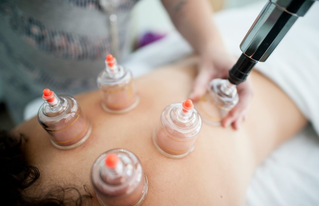 cupping therapy