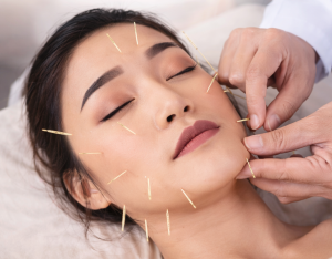 Read more about the article How Cosmetic Acupuncture Rejuvenates Your Skin Naturally