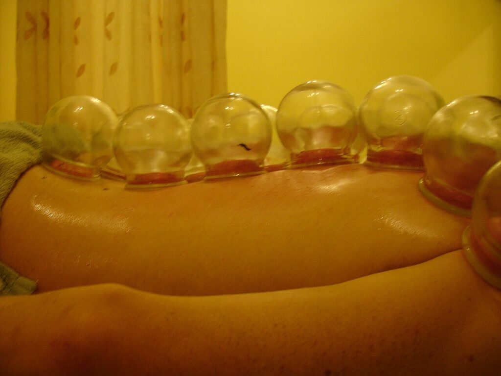 cupping therapy